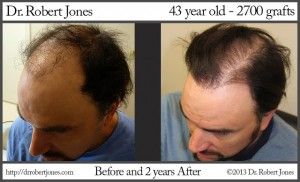 hair-transplants-went-wrong.jpg