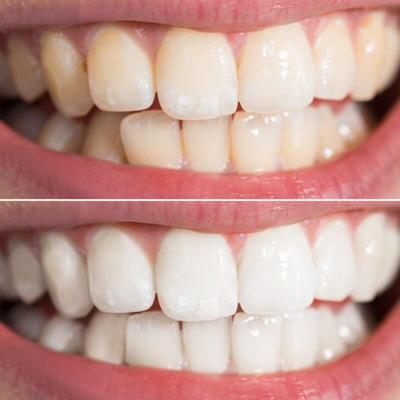 6 Features of Teeth Whitening You Didn’t Know